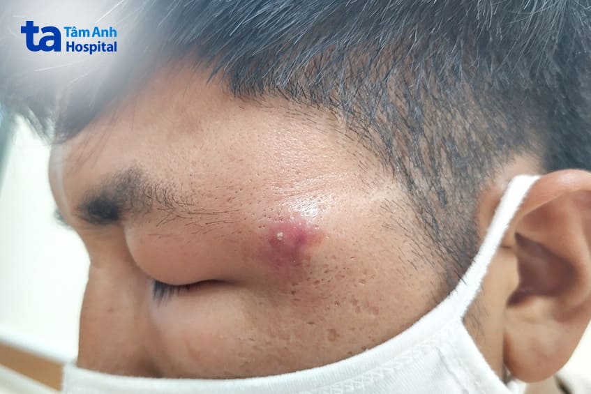 Nếu không điều trị dễ mờ mắt