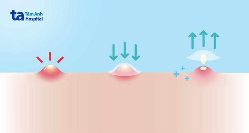 nguyên nhân gây mụn trứng cá mủ