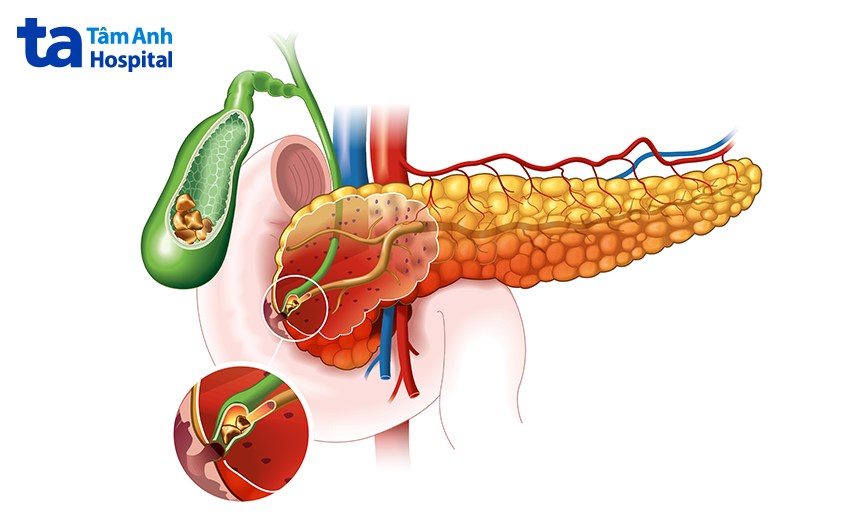 nguyên nhân viêm túi mật cấp