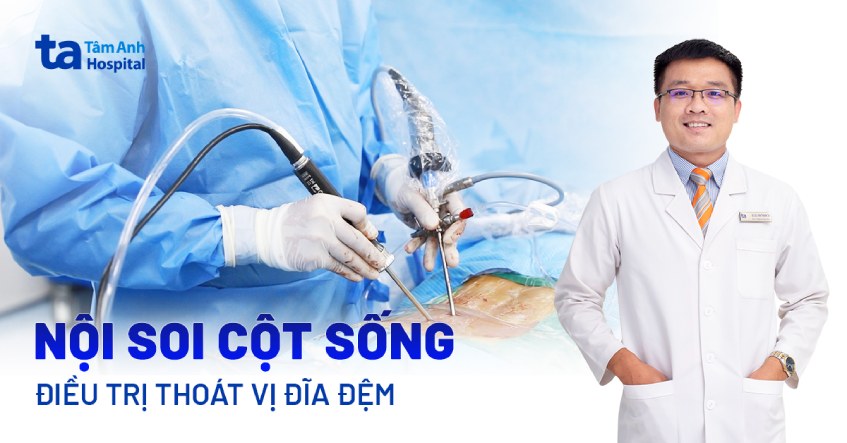 Nội soi cột sống điều trị thoát vị đĩa đệm lâu năm