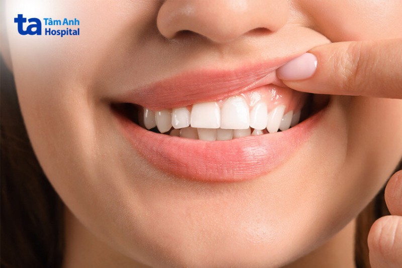 Nướu răng bình thường