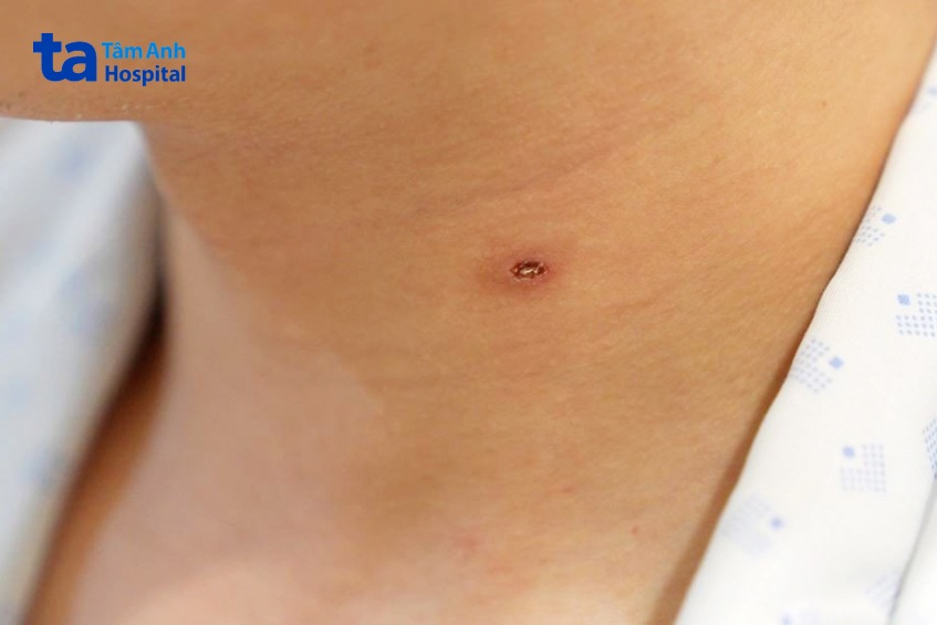 ong vò vẽ đốt trên cổ