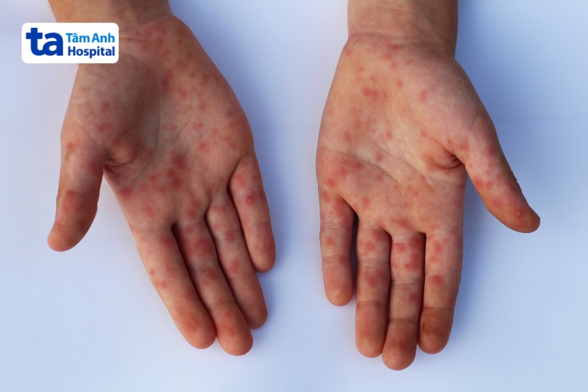 phát ban đỏ nổi nhiều tập trung chủ yếu ở lòng bàn tay của trẻ