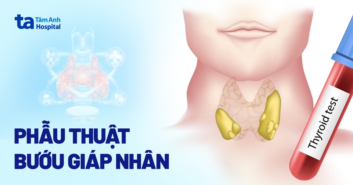 Phẫu thuật bướu giáp nhân