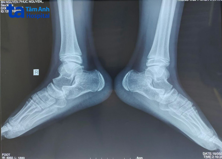 Phim chụp Xquang trước phẫu thuật