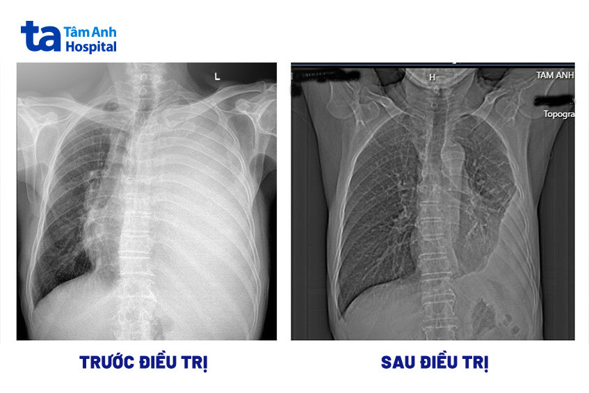 Phổi bệnh nhân trước và sau điều trị