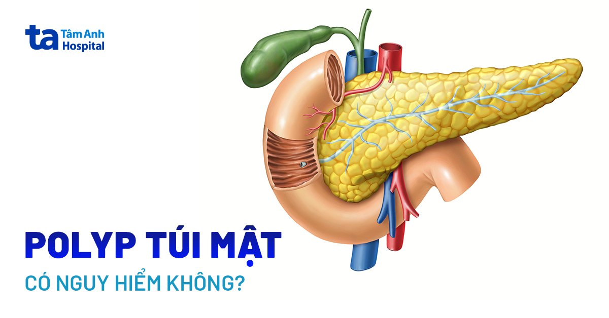 Bị polyp túi mật có nguy hiểm không? Cần phải lưu ý gì?