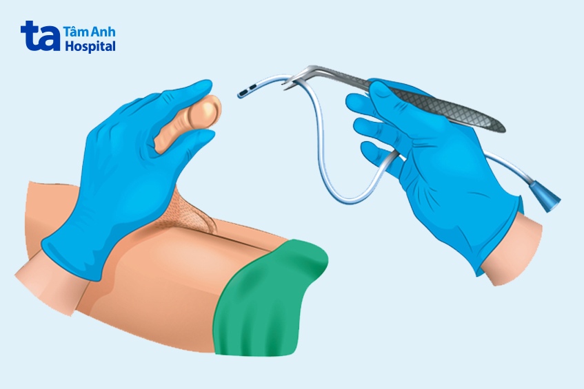 quy trình đặt ống thông tiểu nam