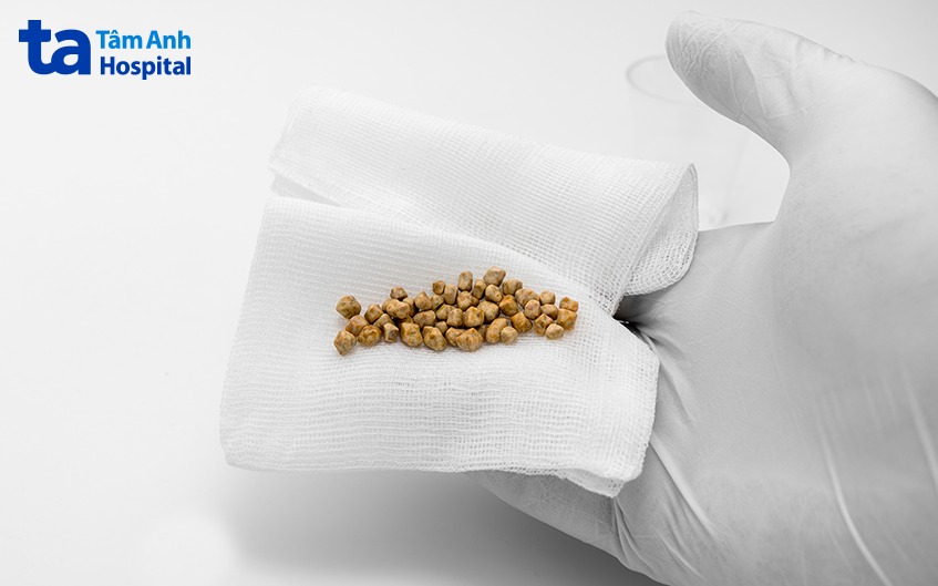 sỏi túi mật bao nhiêu mm là nguy hiểm