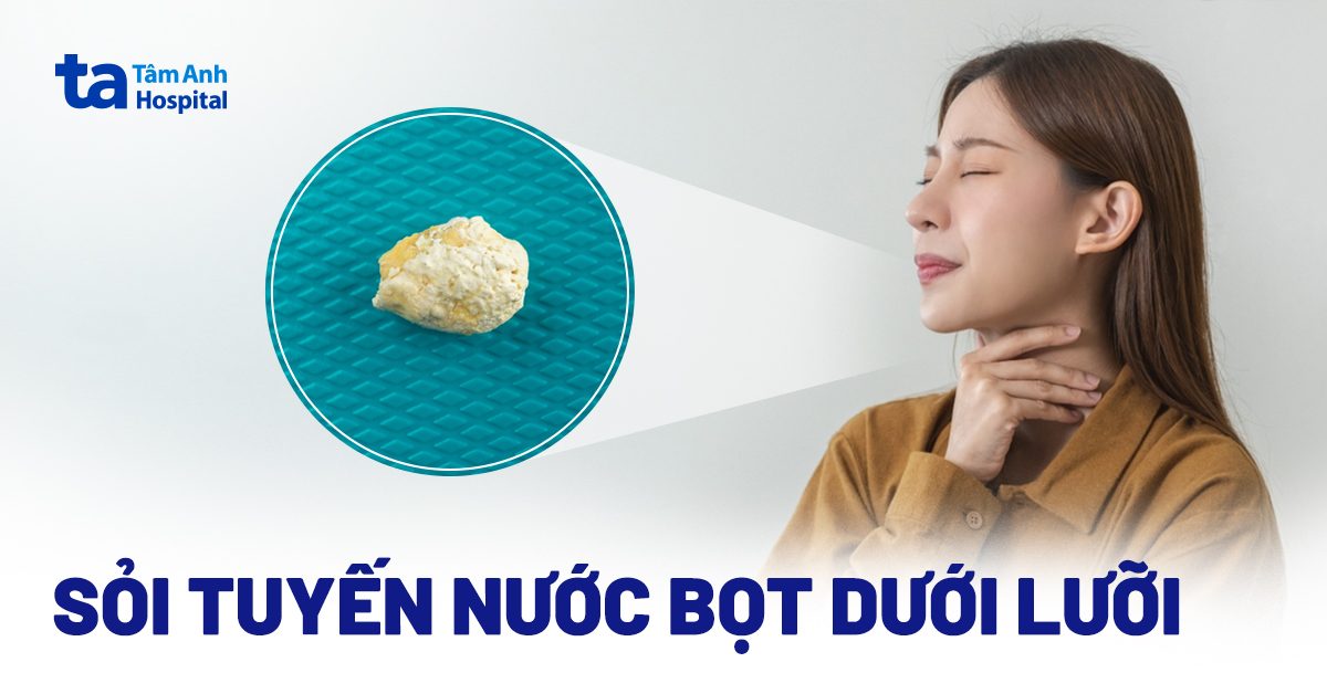 Sỏi tuyến nước bọt dưới lưỡi: Dấu hiệu, nguyên nhân và phòng ngừa