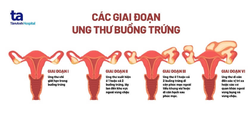 tiên lượng ung thư buồng trứng theo giai đoạn