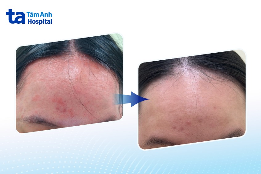 trước và sau khi tiêm thuốc