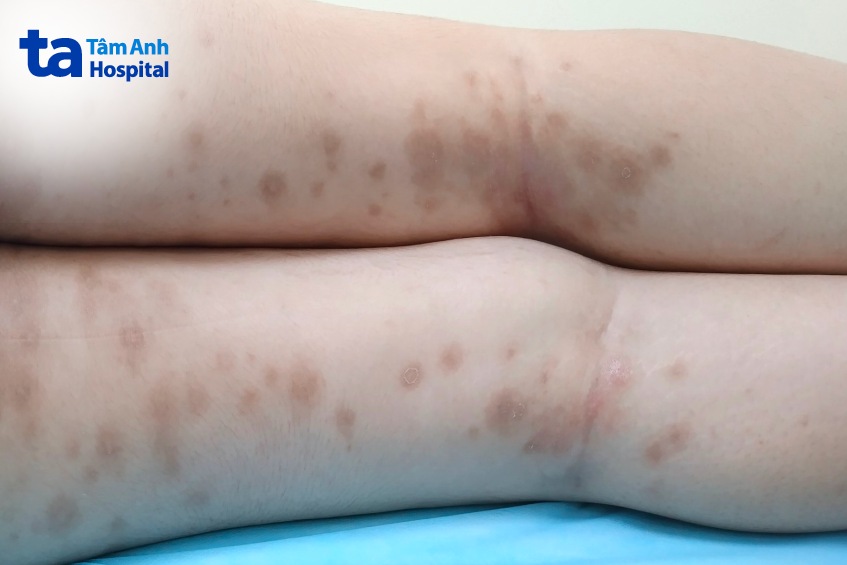 bệnh nhân vảy nến ở chân
