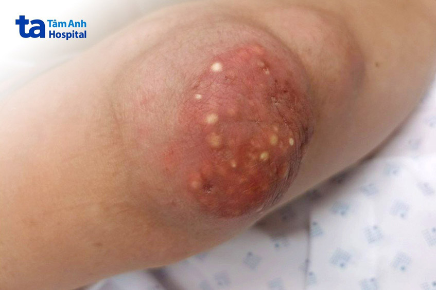 tình trạng gout ở bệnh nhân