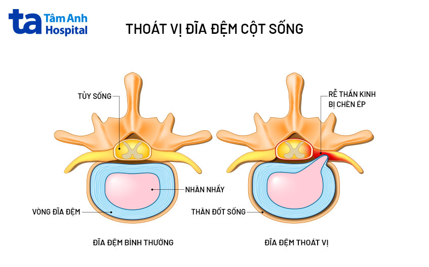 tình trạng thoát vị nhân đĩa đệm