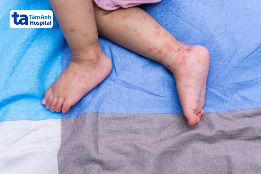 trẻ bị bệnh tay chân miệng trở nặng