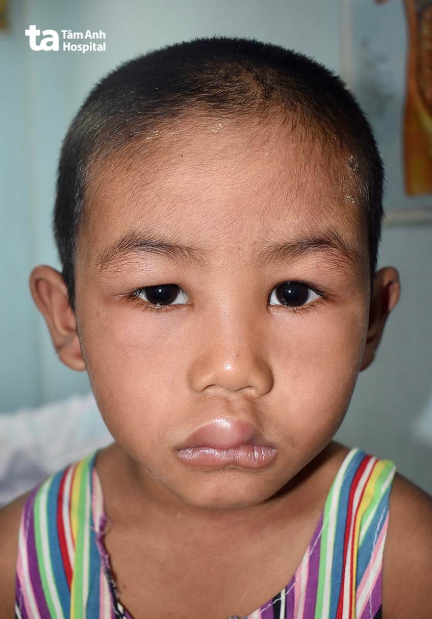 Trẻ bị sưng phù mắt, môi do hội chứng thận hư