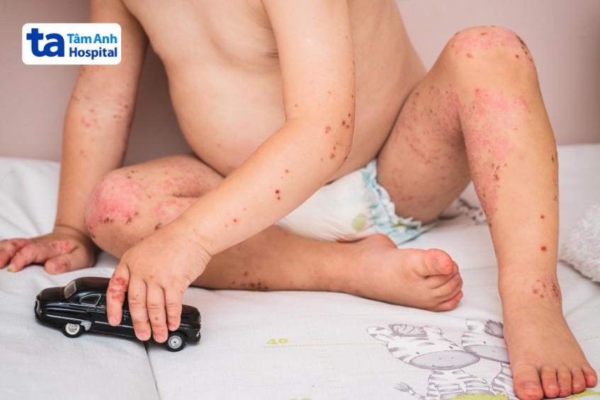 trẻ bị tay chân miệng cấp độ 3 nổi ban đỏ khắp người