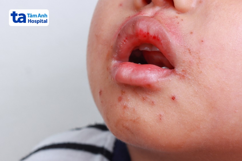 trẻ bị tay chân miệng độ 3 với nhiều đốm ban đỏ