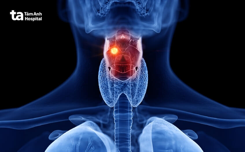 triệu chứng ung thư thanh quản giai đoạn 2