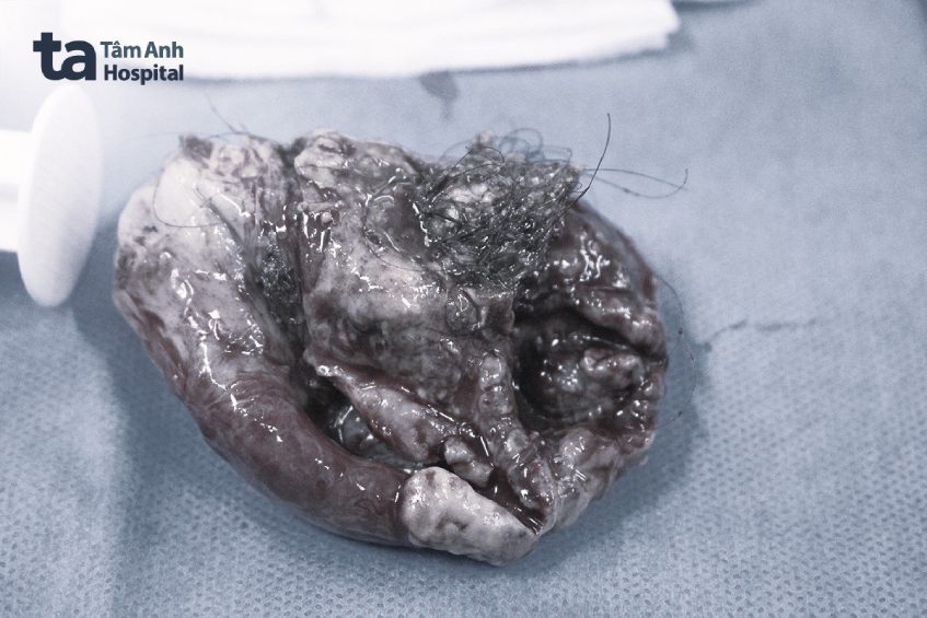 U buồng trứng quái vật