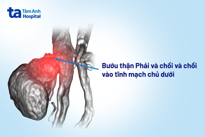 ung thư thận xâm lấn gần tim