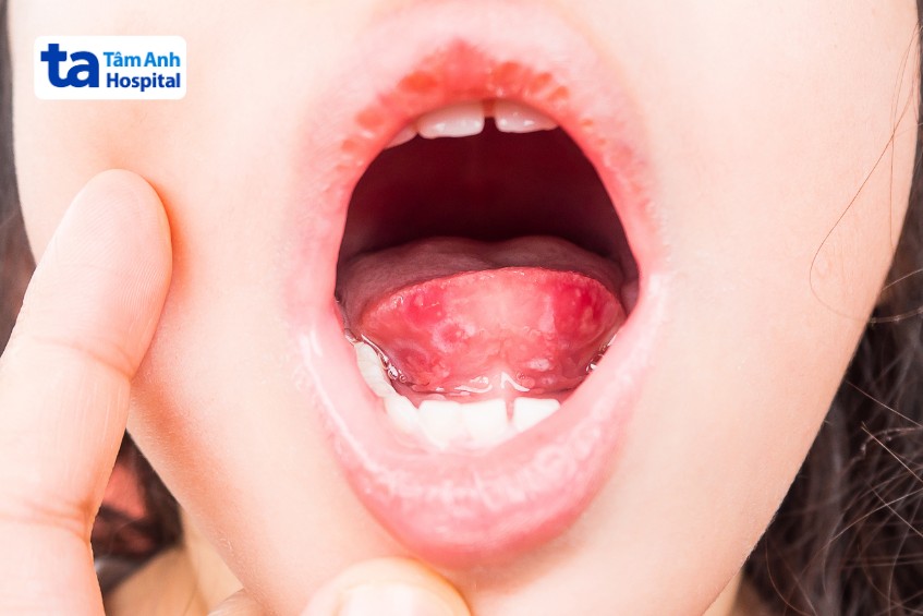 vết loét miệng khiến trẻ đau rát họng