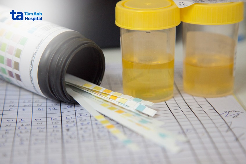 Viêm cầu thận có thể khiến protein và máu lẫn trong nước tiểu