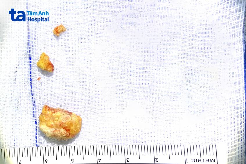 viên sỏi dưới hàm