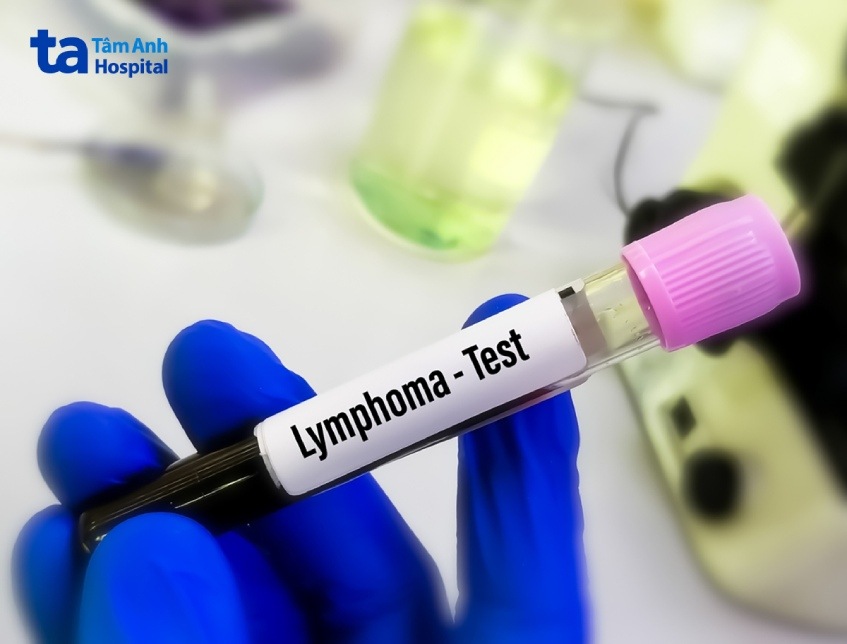 xét nghiệm chẩn đoán lymphoma hodgkin