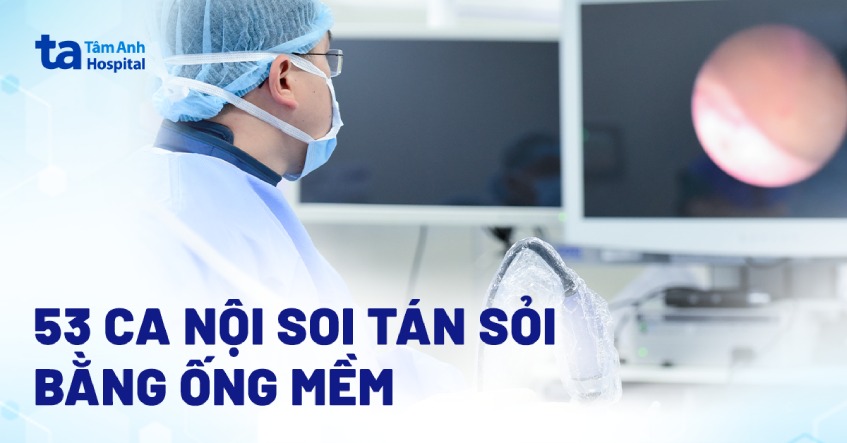 2 năm thực hiện hơn 53 ca nội soi tán sỏi bằng ống mềm