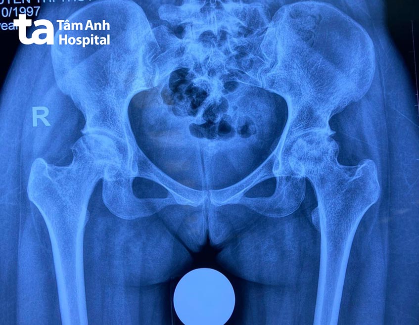 ảnh chụp phim x quang khớp háng