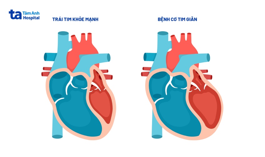 Bệnh cơ tim giãn khiến các buồng tim bị mỏng và căng ra