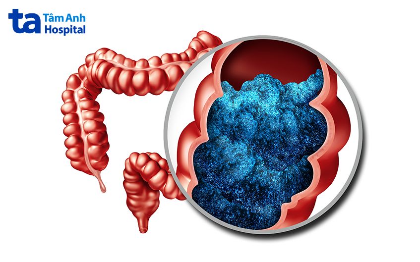 bệnh lý đường ruột