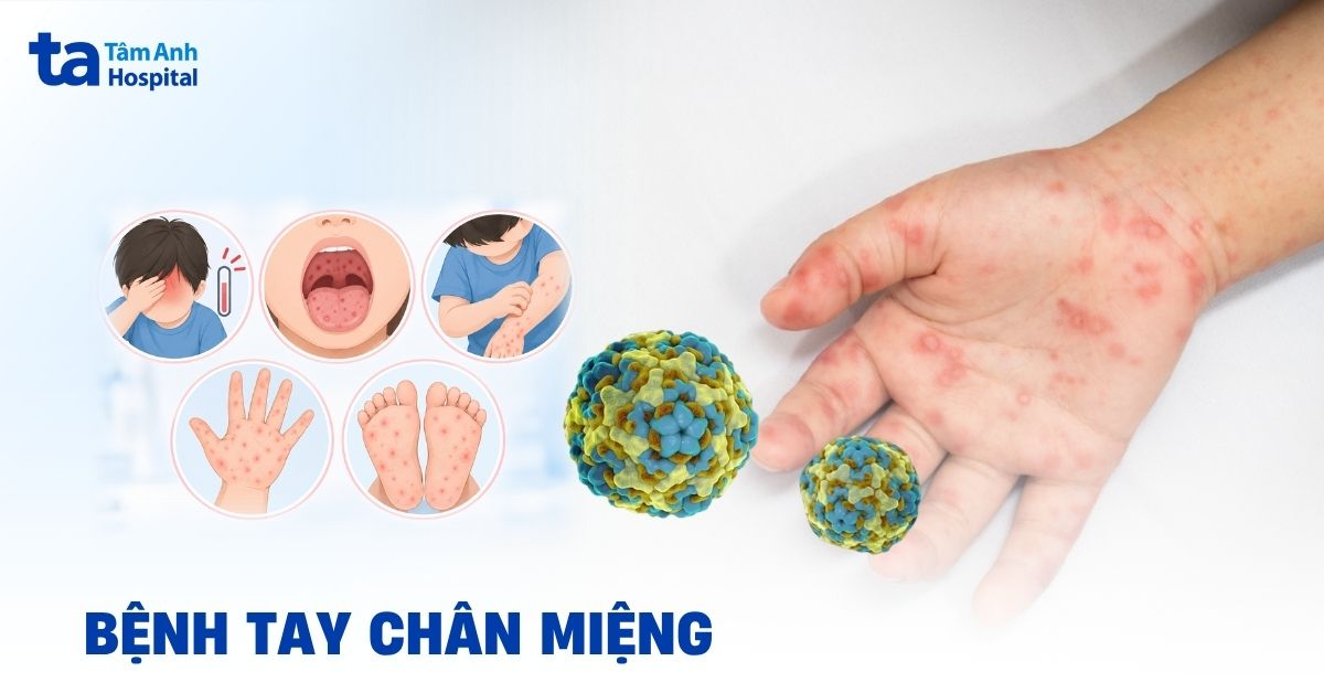 Bệnh tay chân miệng: Dấu hiệu, nguyên nhân và chẩn đoán