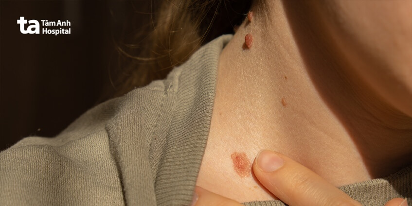 bệnh ung thư da sống được bao lâu