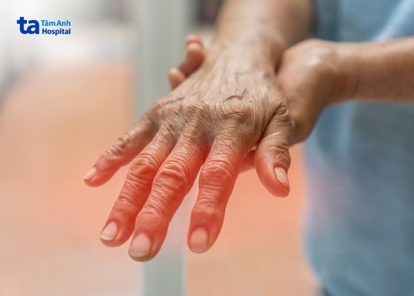 bị viêm đa dây thần kinh