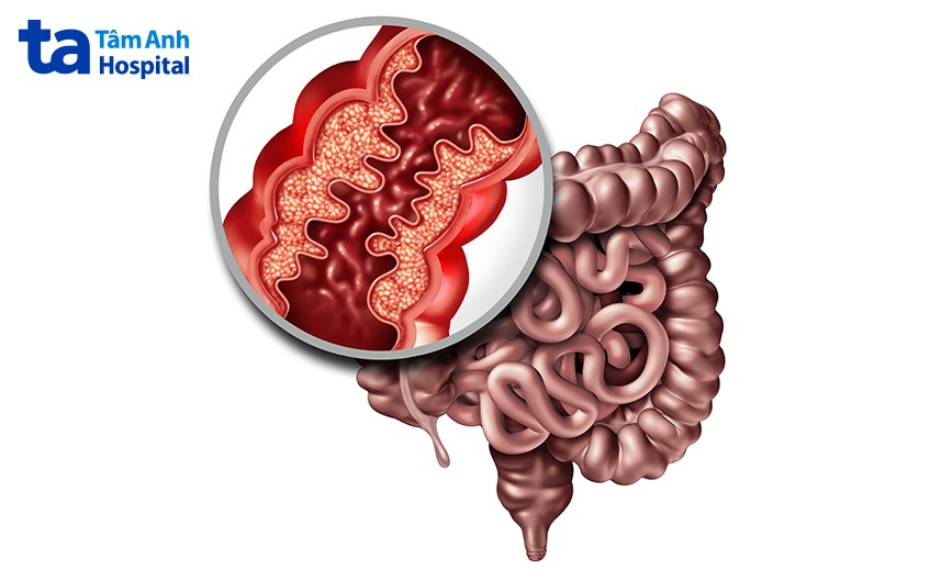 các bệnh đường ruột
