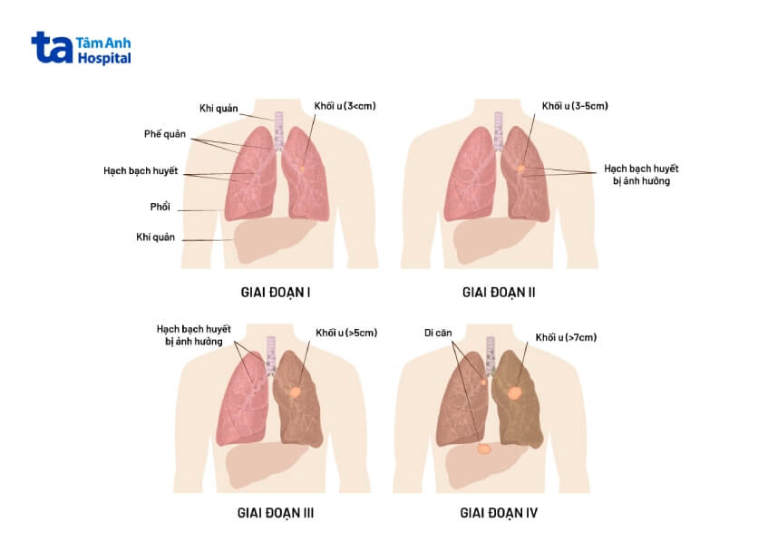các giai đoạn bệnh ung thư phổi