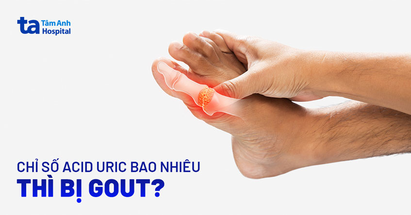 Chỉ số acid uric bao nhiêu thì bị gout? Có nguy hiểm không?