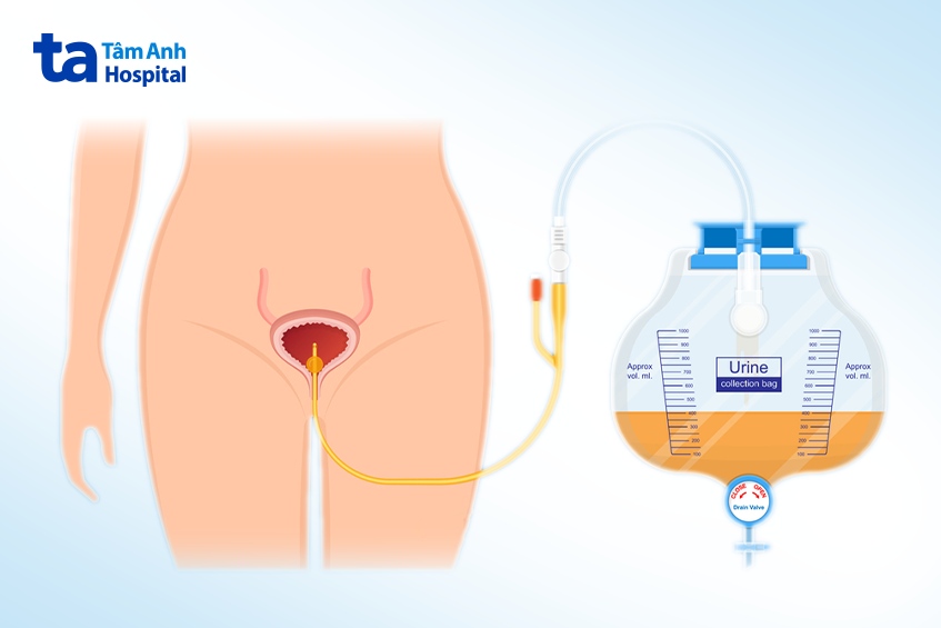 đặt ống thông tiểu là gì