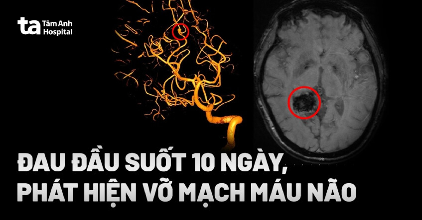 Đau đầu suốt 10 ngày, phát hiện vỡ mạch máu não
