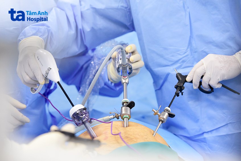 đưa 4 trocar vào ổ bụng bệnh nhân