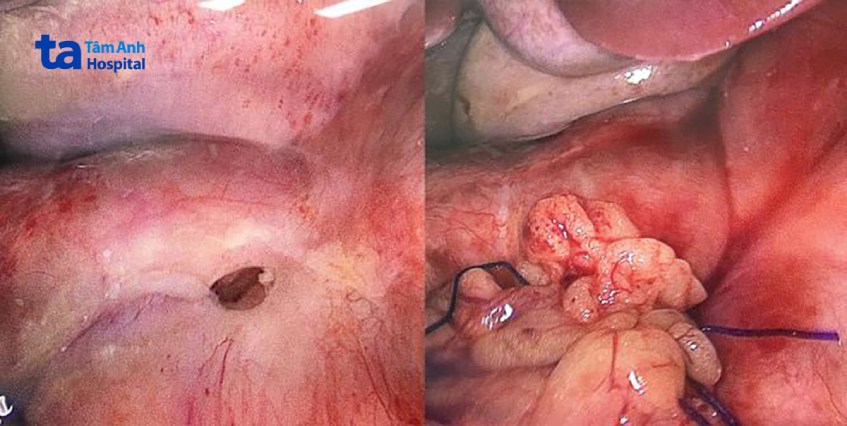 Hành tá tràng của bệnh nhi bị thủng