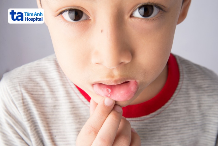 hình ảnh bệnh tay chân miệng ở trẻ với vết loét ở miệng