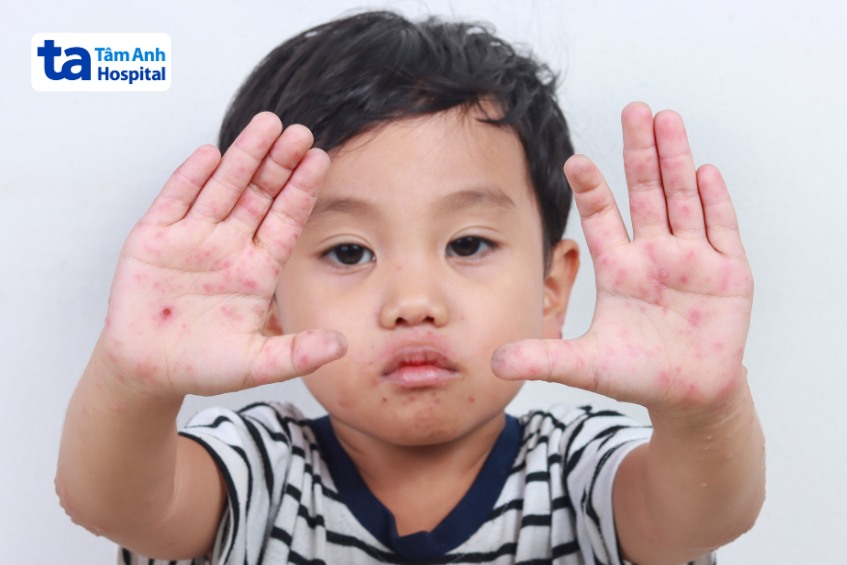 hình ảnh bệnh tay chân miệng phát ban ở tay
