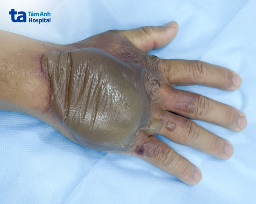 hình ảnh bỏng tay