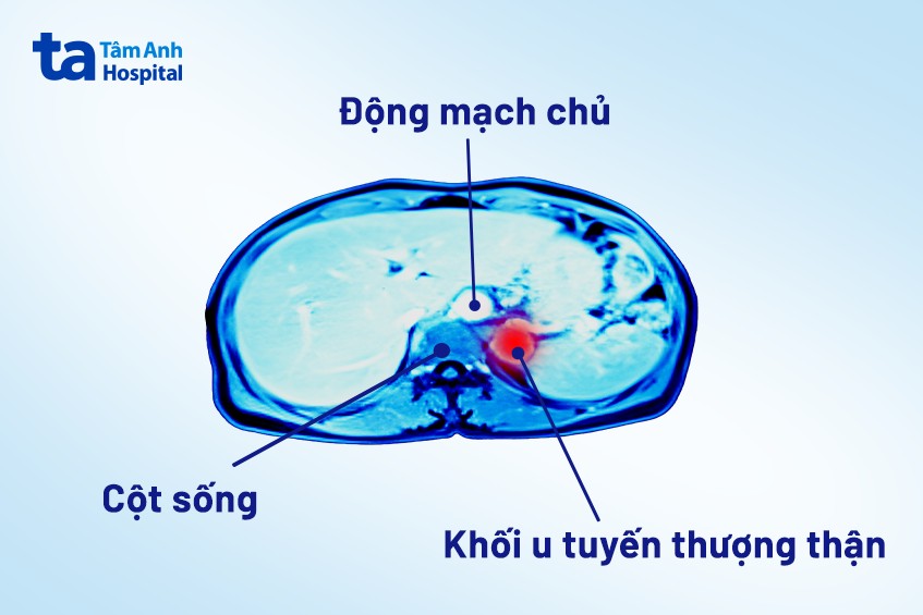 Hình khối u tuyến thượng thận qua hình ảnh chụp MRI