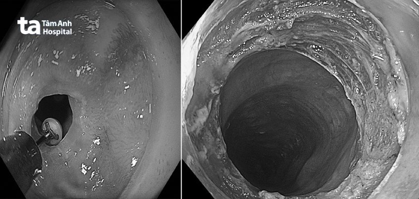 Hình ảnh nội soi thực quản