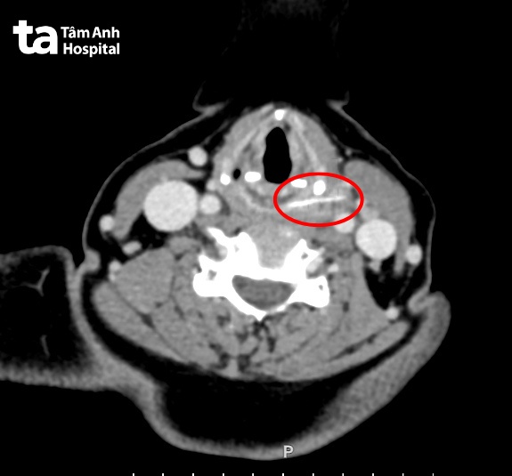 hình ảnh xương cá qua chụp ct